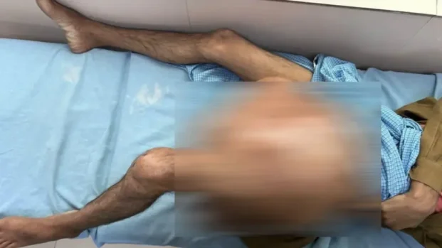 छह साल से पैर पर था 35 किलो का ट्यूमर, एम्स ऋषिकेश ने की सफल सर्जरी, युवक को मिली नई जिंदगी