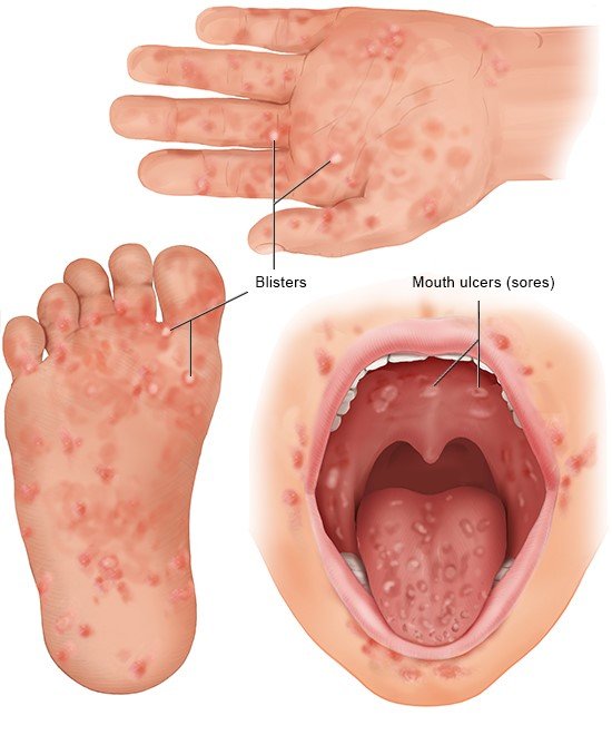बच्चों से लेकर बड़ों तक में फैल रही Hand Foot Mouth Disease, जानिए लक्षण और बचाव